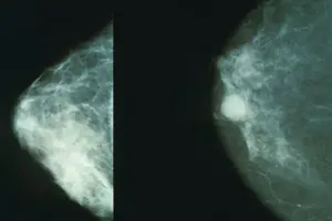 The breast cancer mortality rate for Hispanic women in El Paso is significantly higher.