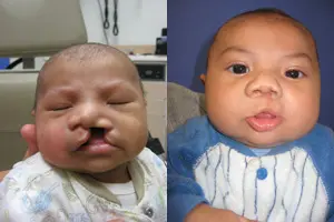 If the lip is open up to and including the floor of the nose, it is called a complete cleft lip.