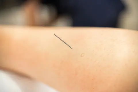 image of physiotherapist peforming dry needling