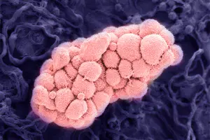 Ovarian epithelial cancer, which begins in the tissue that covers the ovaries, is the most common type of ovarian cancer.