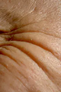 Laser treatments like those offered at Texas Tech Physicians  Dermatology can help diminish wrinkles, acne scars, blood vessels and sun spots.